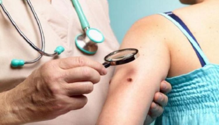 الولايات المتحدة.. باحثون يطورون رقعة ذكية للكشف المبكر عن سرطان الجلد